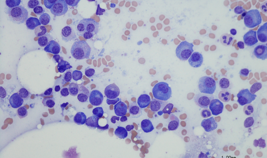Multiple Myeloma